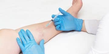 Leg Pain Relief With Radiofrequency Ablation